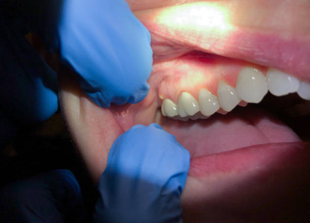 Best Emergency Treatment for Dental Infections or Abscesses in Western Springs, IL