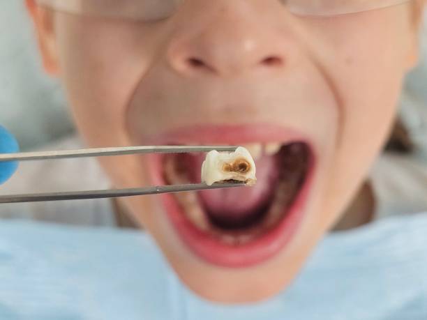 Best Emergency Dental Care for Broken or Chipped Teeth in Western Springs, IL